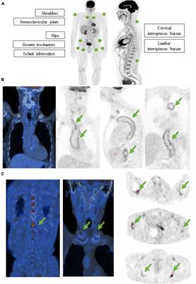 Role and potential of 18F-fluorodeoxyglucose-positron emission tomography-computed tomography in large-vessel vasculitis: a comprehensive review